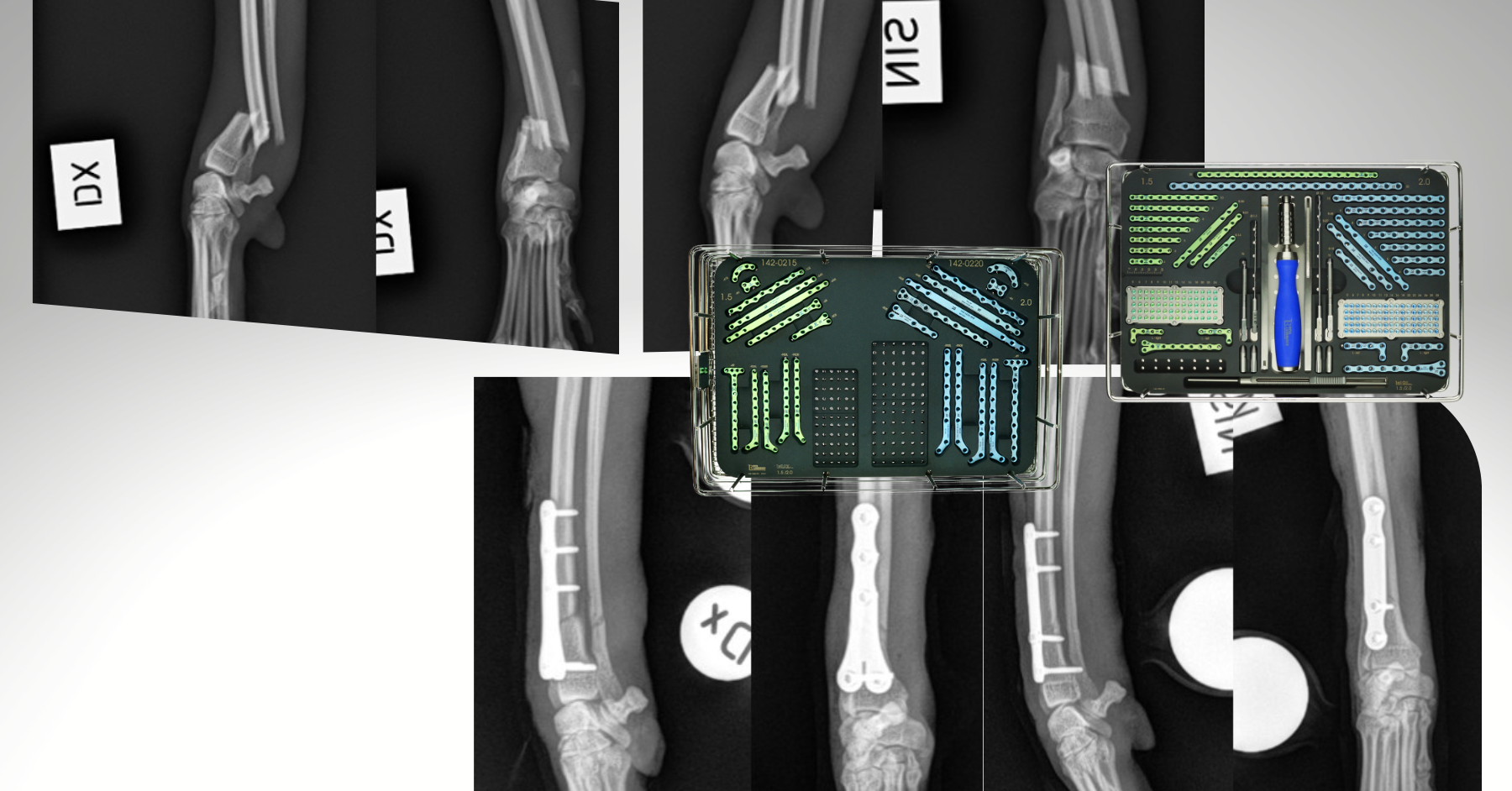 3D HIP, patient-specific 3D-printed Titanium Implant 3D HIP Shelf Implant