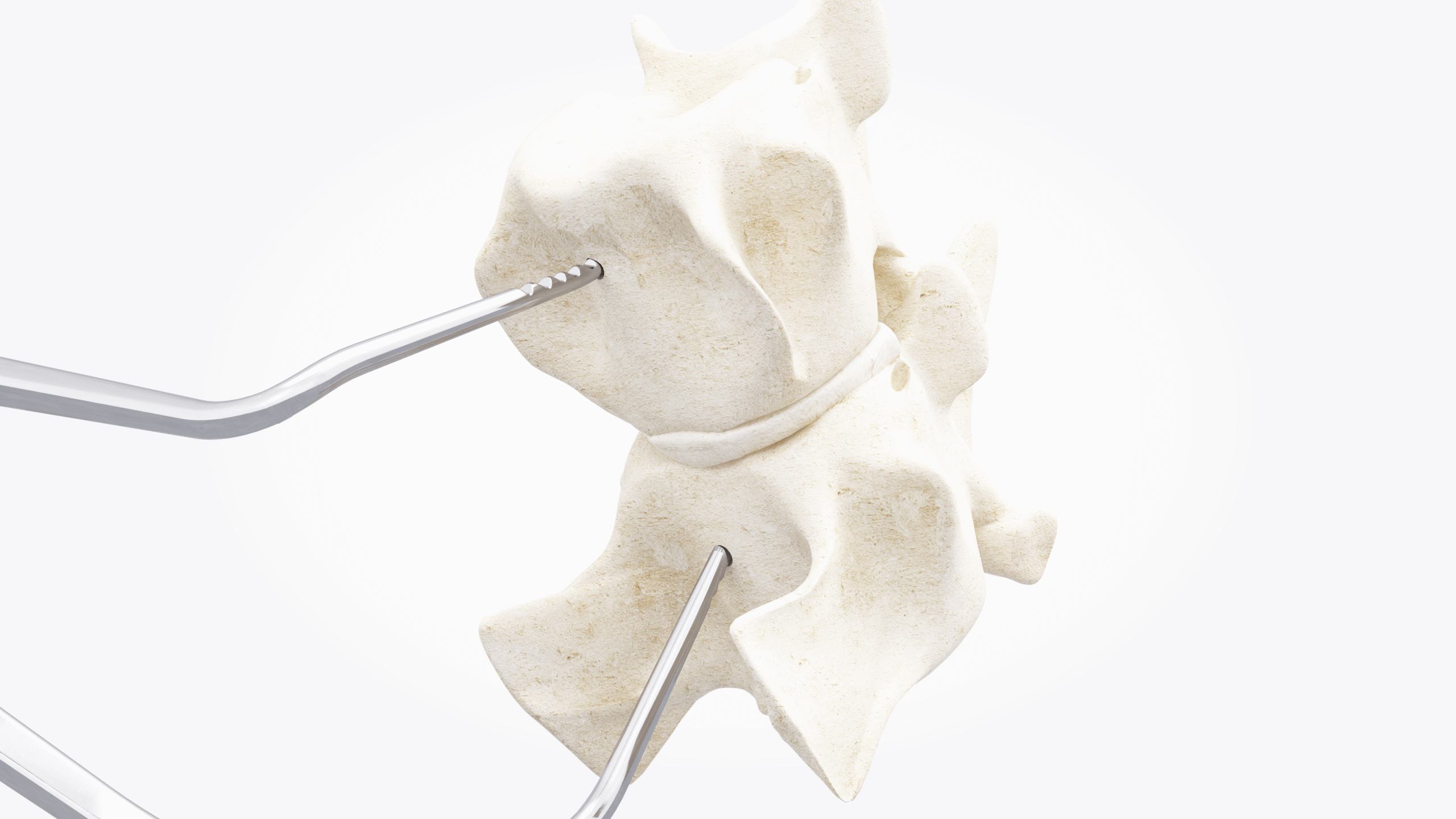 3.2_Place C-LOX Distractor