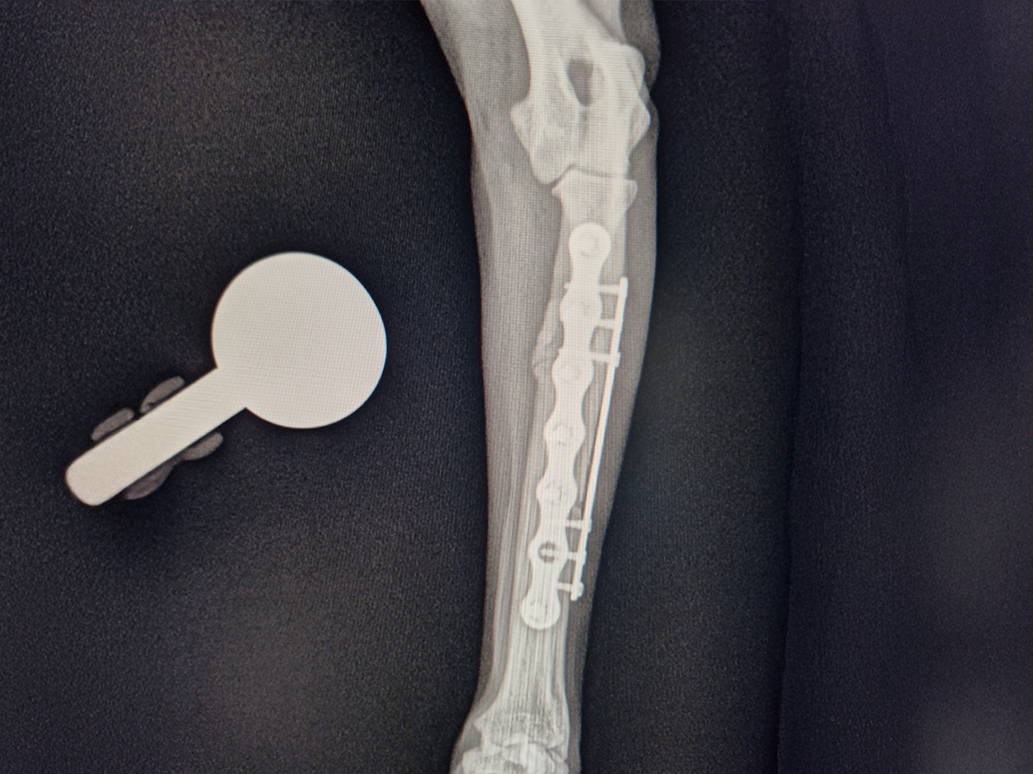 5 - Rita Leibinger Medical - New 1.0 mm LeiLOX Plate