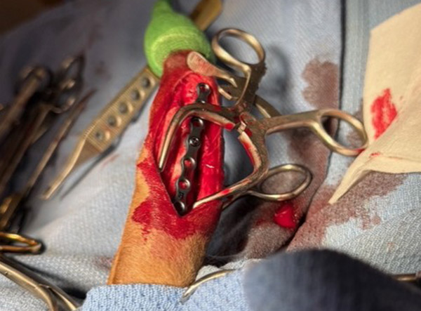 5 - Fracture Case LeiLOX 2.0 mm Titanium Locking Plate - Dr. Jeff Mayo