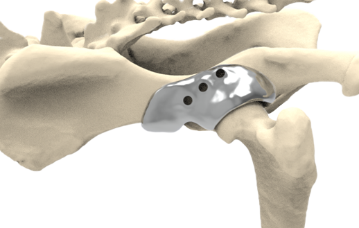 3D HIP, patient-specific 3D-printed Titanium Implant 3D HIP Shelf Implant