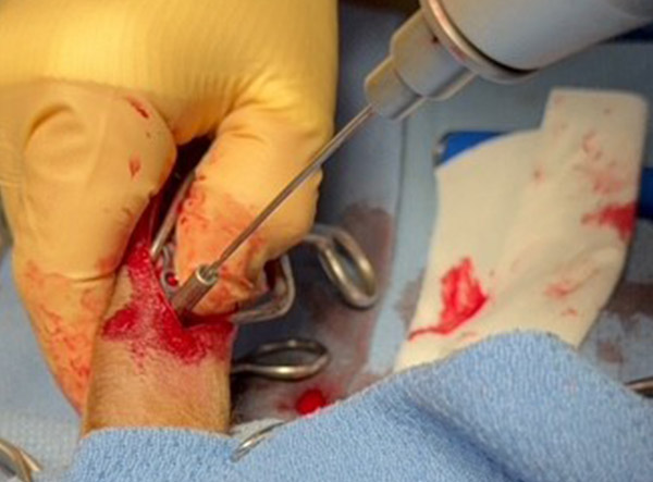 4 - Fracture Case LeiLOX 2.0 mm Titanium Locking Plate - Dr. Jeff Mayo