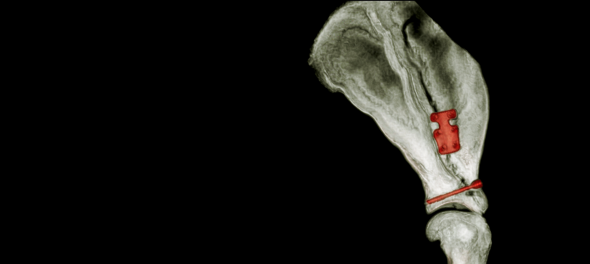 TPLO Patella Luxation Spacer TPLO Patella Luxation Spacers